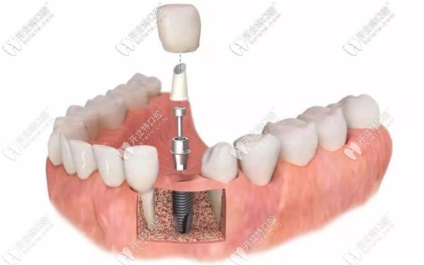 烏魯木齊做種植牙的參考價(jià)格
