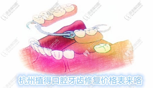 杭州植得口腔鑲牙費用表來咯,各種活動義齒的修復價格都有
