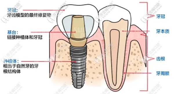 廣州穗華口腔的半口全固定種植牙價格超劃算