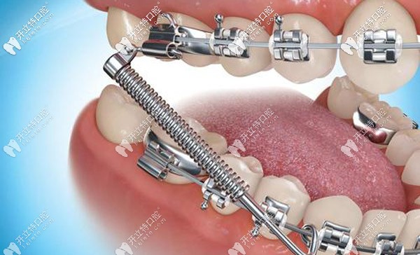 正畸托槽老是掉怎么辦，托槽掉了對(duì)矯正牙齒有影響嗎