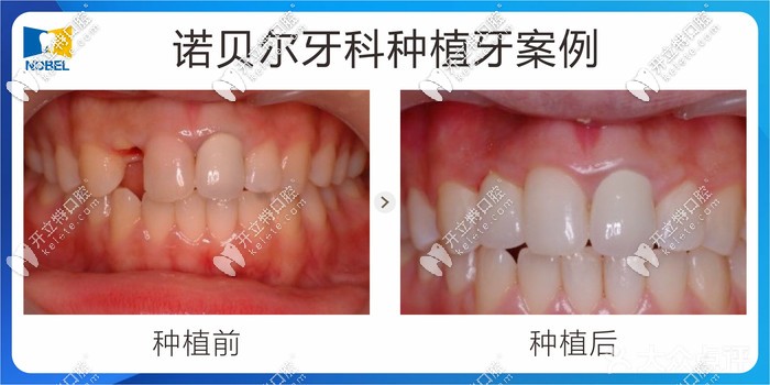 西安諾貝爾口腔價(jià)格表5家連鎖店通用~電話預(yù)約種植牙3390元