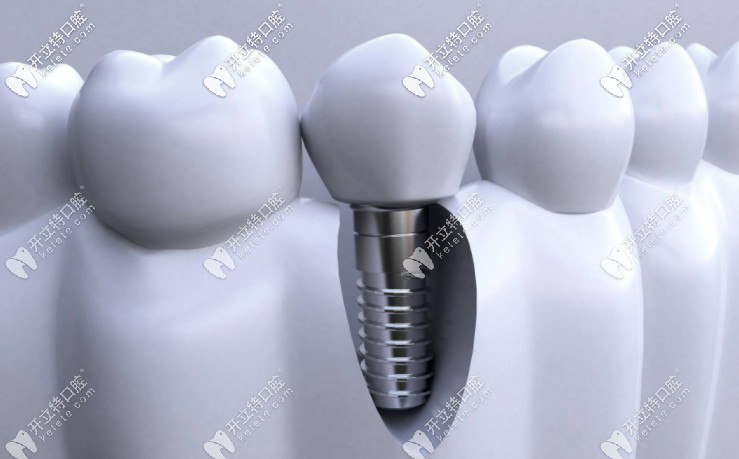 成都種植全口牙的價(jià)格是多少？附種牙醫(yī)生推薦！