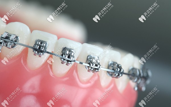 在大同做牙齒矯正的費用整體不算貴