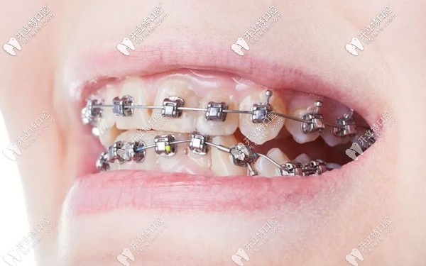 大同金屬托槽矯正的參考價格