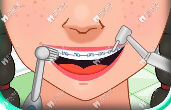 關(guān)于西寧牙齒矯正