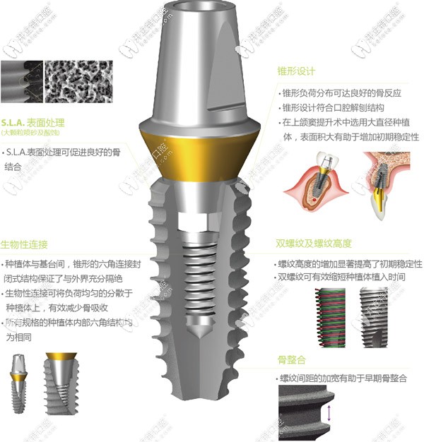 韓國(guó)superline種植系統(tǒng)的特點(diǎn)