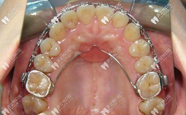 腭側(cè)nace弓矯正圖片