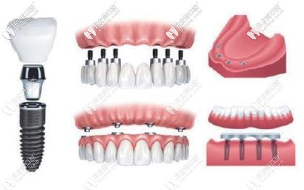 溫州市做全口種植牙價(jià)格是多少錢!上萬的種植牙值得做嗎?