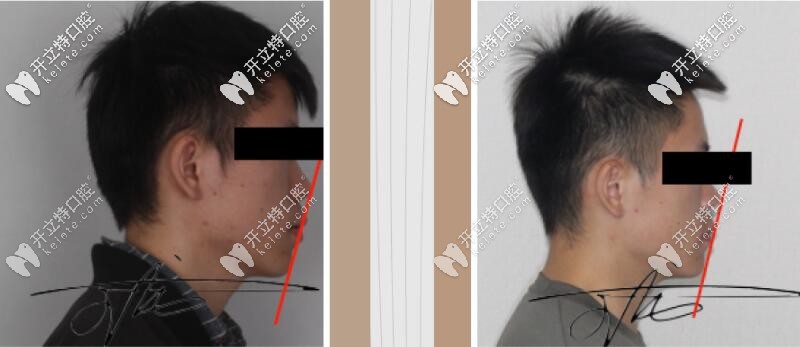 王龍醫(yī)生矯正案例