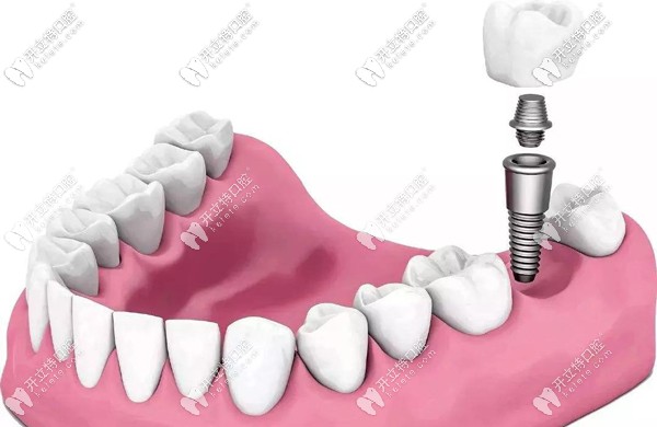 全新的廣州廣大口腔種植牙價(jià)格表已整理好,含7國植體品牌哦