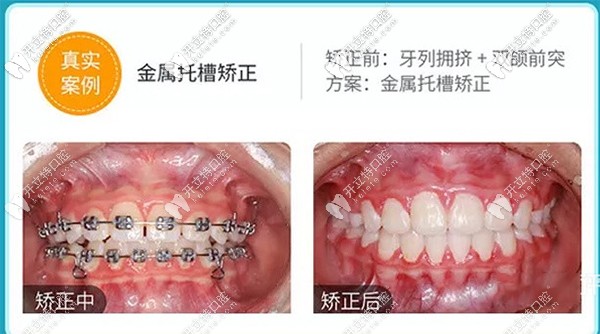 金屬托槽矯正真實(shí)案例