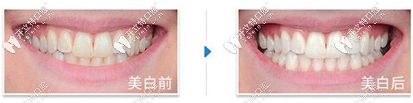 皓齒美白真實(shí)案例