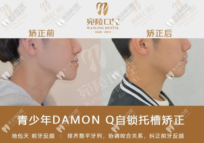 地包天矯正前后臉型對比照片