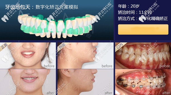 廈門麥芽口腔地包天牙齒矯正案例