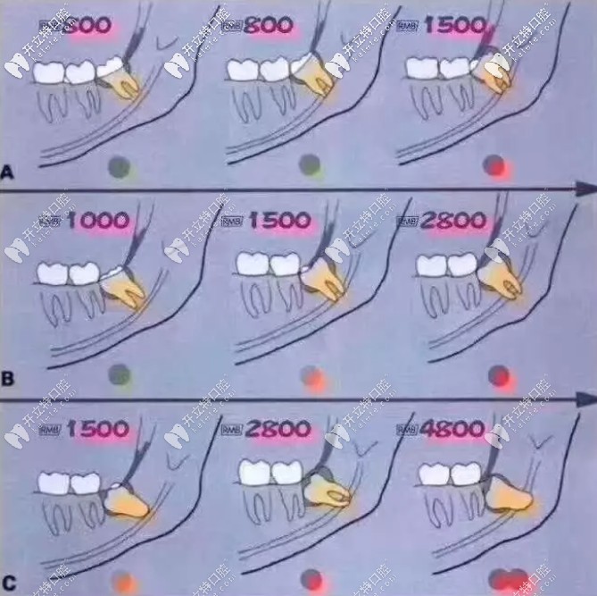 下頜近中傾斜阻生智齒價格表