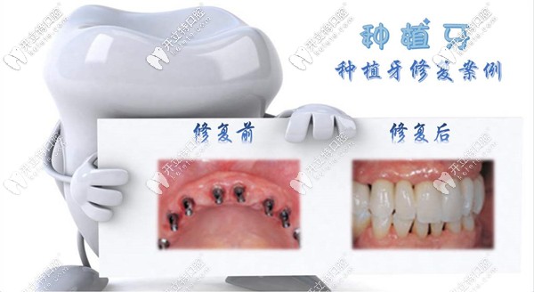 種植牙前后對(duì)比圖