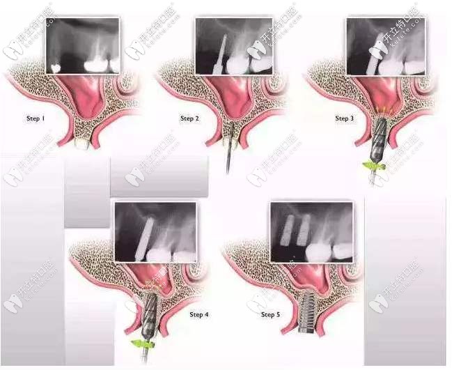 常用的骨增量技術(shù)