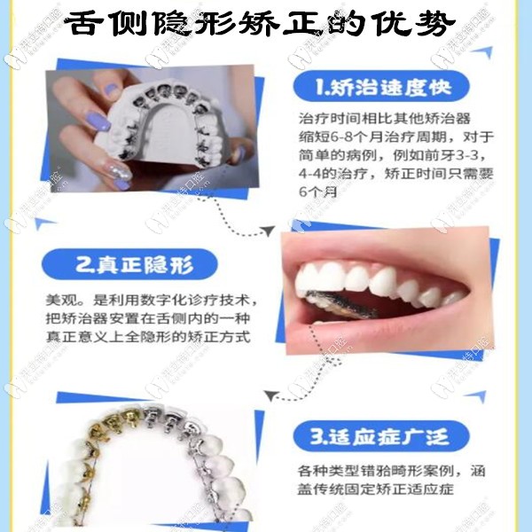 舌側(cè)隱形矯正的優(yōu)勢(shì)