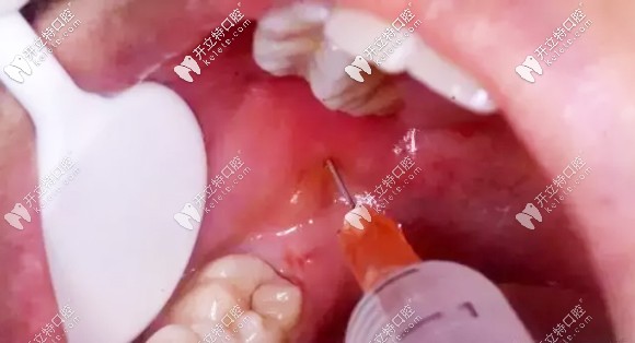 兒童拔牙打麻藥有副作用嗎