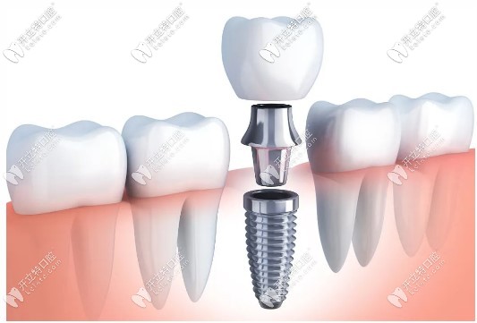 種植牙結(jié)構(gòu)