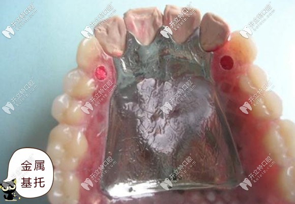 金屬基托的厚度和重量