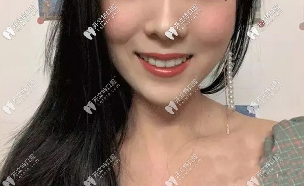 齙牙隱形矯正效果