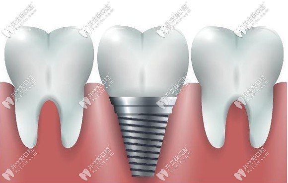 陽泉康貝齒科種植牙價(jià)格 陽泉康貝齒科種植牙價(jià)格