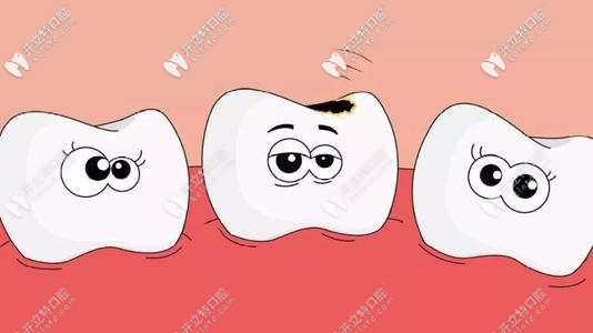 齲齒的初期狀態(tài)