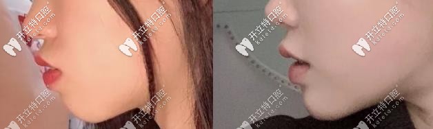 齙牙妹妹牙齒矯正前后變化圖