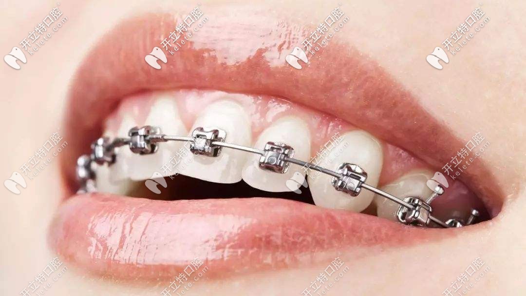 初戴牙套會(huì)感覺(jué)到疼痛