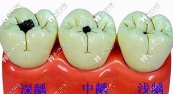 齲齒程度決定了補(bǔ)牙價(jià)格