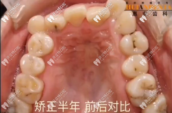 上牙口內(nèi)情況