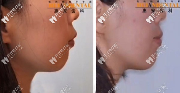 通過(guò)矯正可能獲得一個(gè)下巴哦
