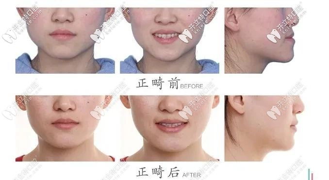 牙齒正畸前后對比圖