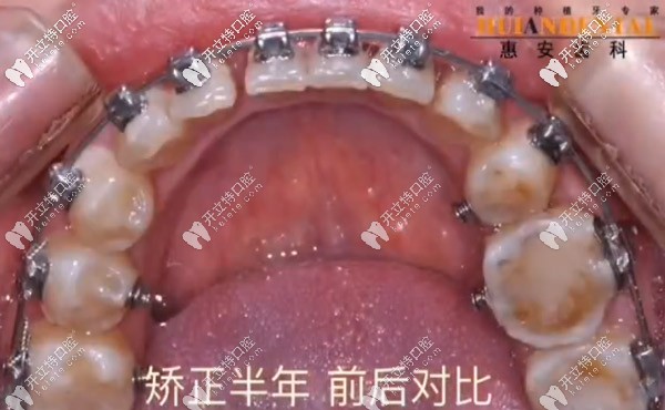 矯正后經(jīng)過(guò)治療沒(méi)有了蛀牙