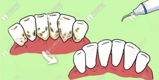 超聲波潔牙圖示 超聲波潔牙圖示