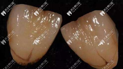 前牙烤瓷冠