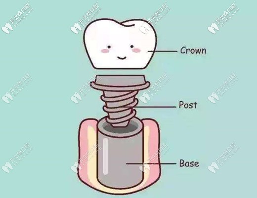 廣州越秀區(qū)中家醫(yī)口腔的種植牙價格