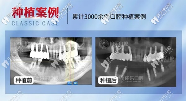 專訪柏樂口腔南湖總院實力派種植醫(yī)生崔金禮-種植修復