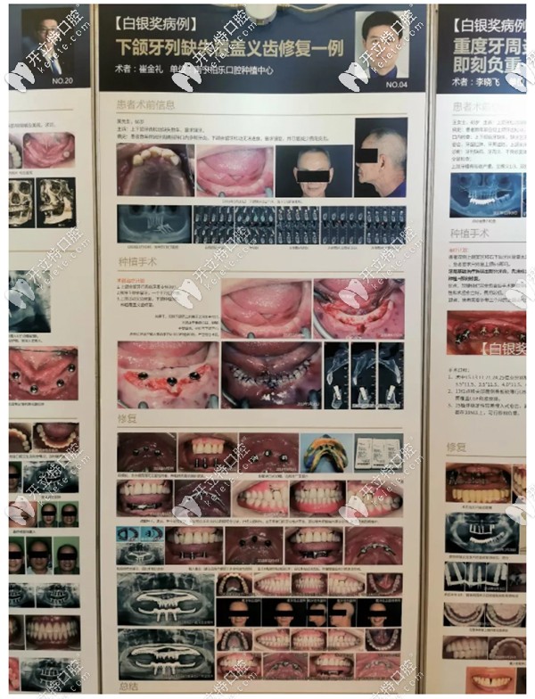下頜牙列缺失覆蓋義齒修復(fù)