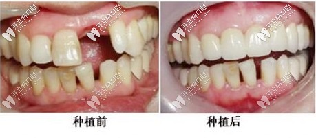 種植牙前后對比