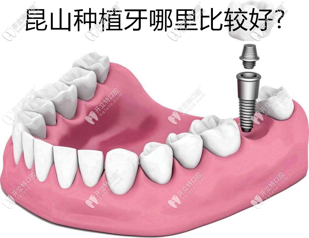昆山種植牙哪里比較好