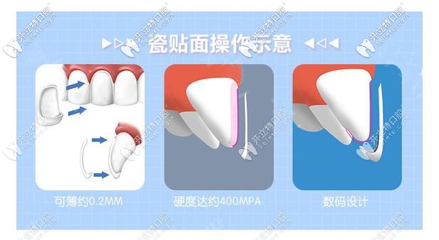 瓷貼面的操作示意圖