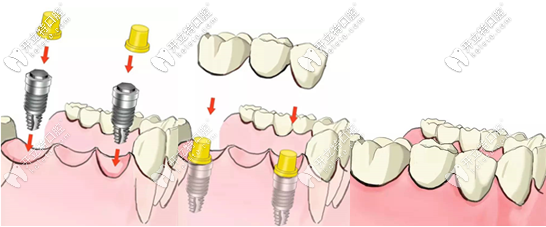 種植牙過(guò)程圖示