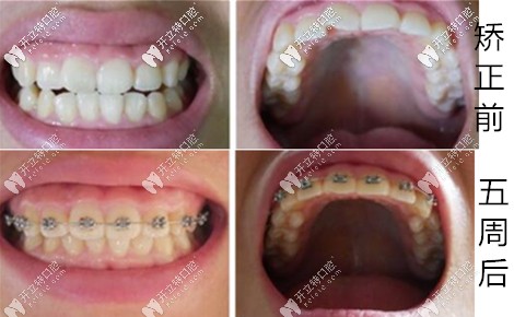 慢性牙周炎牙齒矯正