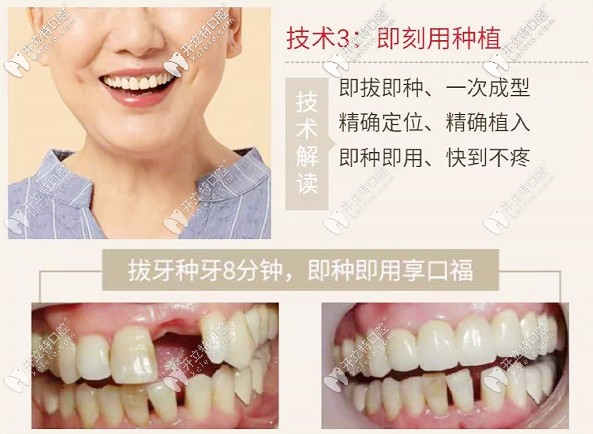 <!--<i data=20240703-sp></i>-->口腔種植牙技術(shù)