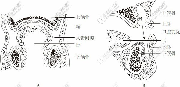 義齒間隙和義齒表面 義齒間隙和義齒表面