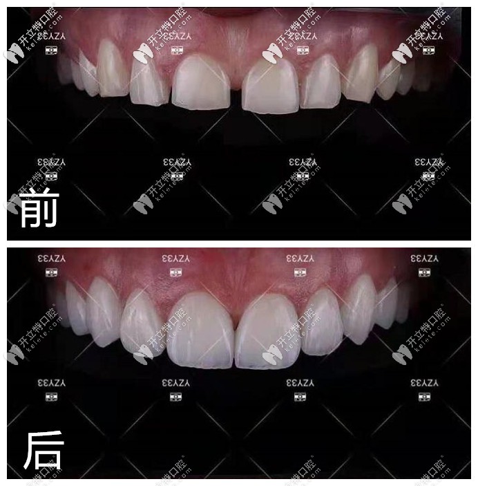 納米水晶瓷貼面修復半口牙前后對比照片