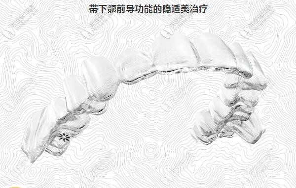  隱適美矯正下頜后縮有用嗎?據(jù)說Invisalign有帶下頜前導功能