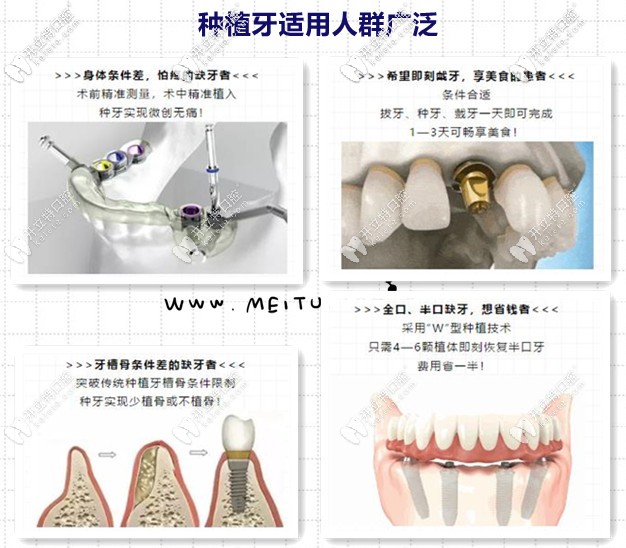 種植牙的優(yōu)勢及適應(yīng)人群